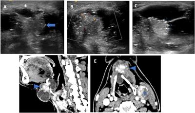 Role of imaging in the management of thyroglossal duct cyst carcinomas (TGC-TIRADS): a single centre retrospective study over 16 years